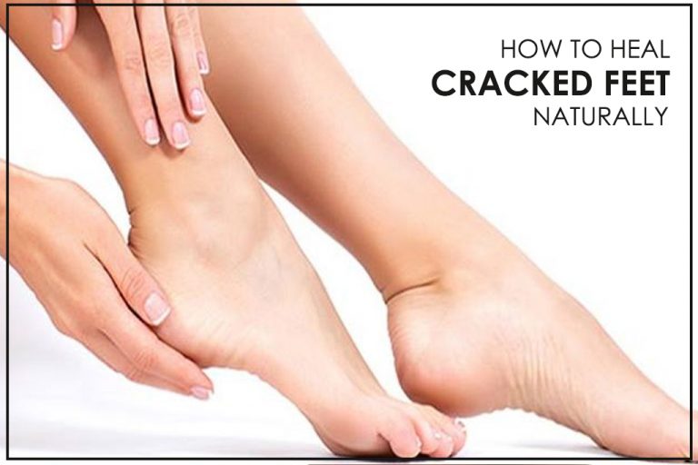 heal-cracked-feet-naturally